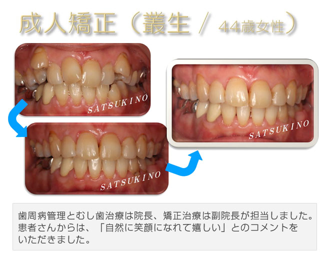 歯周病管理とむし歯治療は院長、矯正治療は副院長が担当しました。患者さんからは、「自然に笑顔になれて嬉しい」とのコメントをいただきました。
