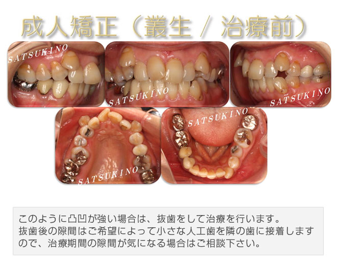 このように凸凹が強い場合は、抜歯をして治療を行います。抜歯後の隙間はご希望によって小さな人工歯を隣の歯に接着しますので、治療期間の隙間が気になる場合はご相談下さい。