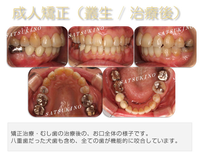 矯正治療・むし歯の治療後の、お口全体の様子です。八重歯だった犬歯も含め、全ての歯が機能的に咬合しています。