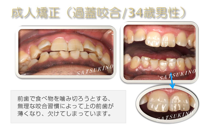 前歯で食べ物を噛み切ろうとする、無理な咬合習慣によって上の前歯が薄くなり、欠けてしまっています。下の歯もかなりすり減っているのがわかります。