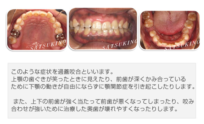 このような症状を過蓋咬合といいます。上顎の歯ぐきが笑ったときに見えたり、前歯が深くかみ合っているために下顎の動きが自由にならずに顎関節症を引き起こしたりします。また、上下の前歯が強く当たって前歯が悪くなってしまったり、咬み合わせが強いために治療した奥歯が壊れやすくなったりします。