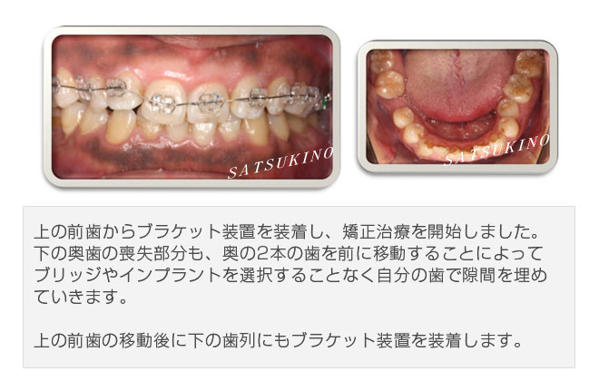 上の前歯からブラケット装置を装着し、矯正治療を開始しました。下の奥歯の喪失部分も、奥の2本の歯を前に移動することによってブリッジやインプラントを選択することなく自分の歯で隙間を埋めていきます。上の前歯の移動後に下の歯列にもブラケット装置を装着します。