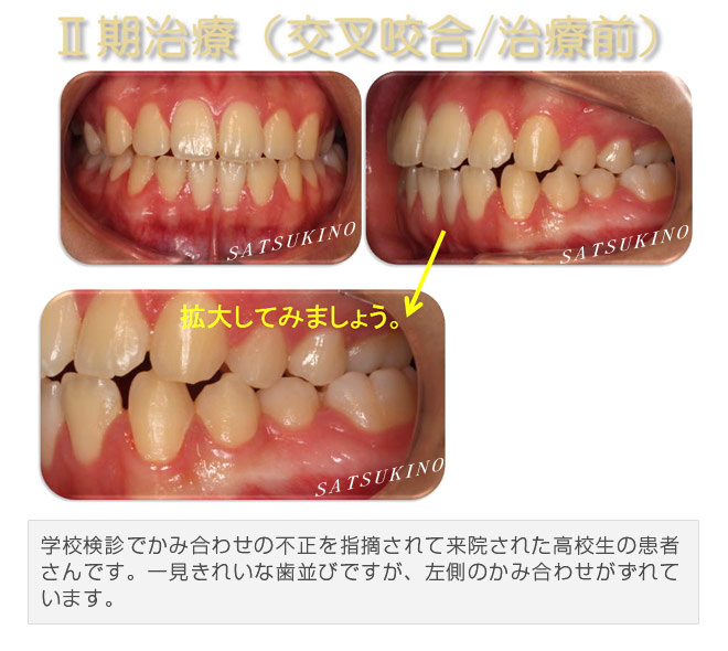 学校検診でかみ合わせの不正を指摘されて来院された高校生の患者さんです。一見きれいな歯並びですが、左側のかみ合わせがずれています。