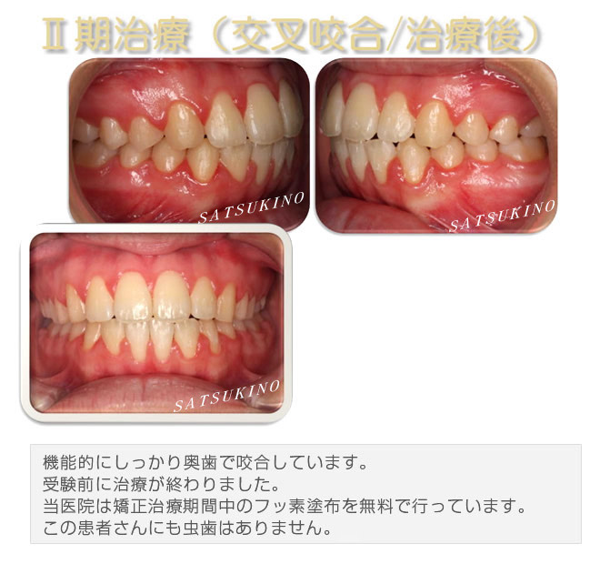 機能的にしっかり奥歯で咬合しています。受験前に治療が終わりました。当医院は矯正治療期間中のフッ素塗布を無料で行っています。この患者さんにっも虫歯はありません。