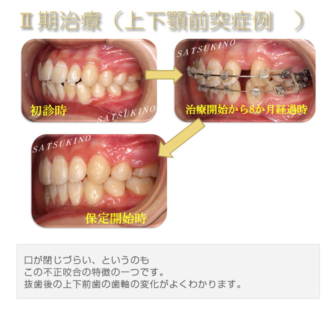 口が閉じづらい、というのも、この不正咬合の特徴の一つです。抜歯後の上下前歯の歯軸の変化がよくわかります。