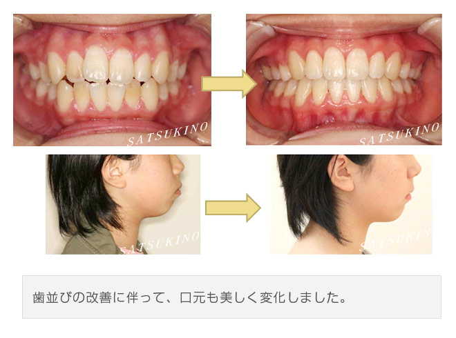 歯並びの改善に伴って、口元も美しく変化しました。