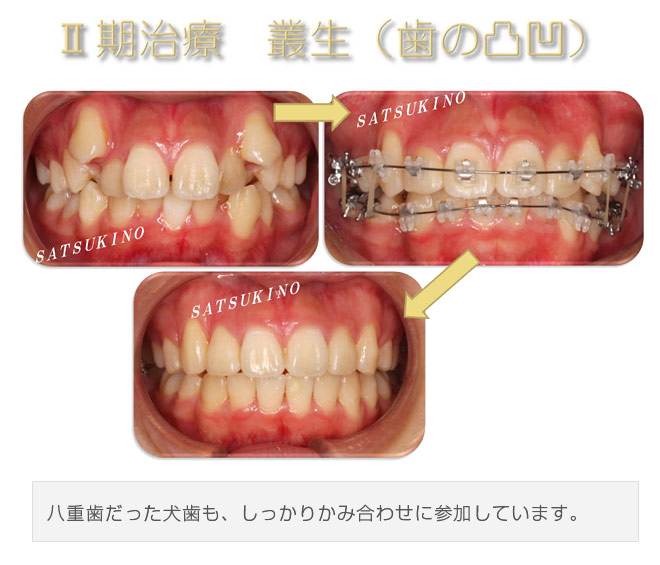 八重歯だった犬歯も、しっかりかみ合わせに参加しています。